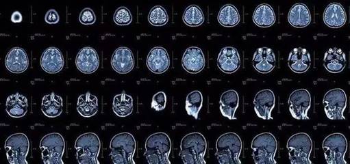 神经内科常见疾病 CT与磁共振的选择指南